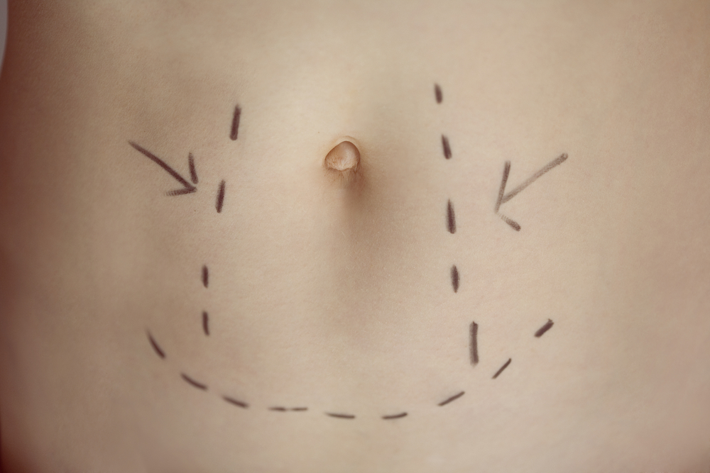 Tummy tuck procedure markings