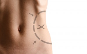Body procedure markings