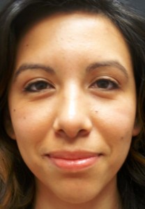 2004 Rhinoplasty-6 Months After (2)