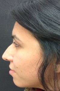 2004 Rhinoplasty-Before