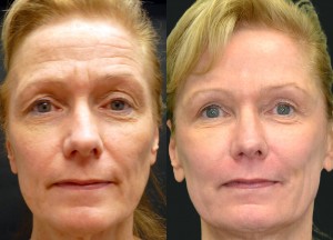 Laser resurfacing, fillers, botox, upper blepharoplasty, fat grafting before and after pictures