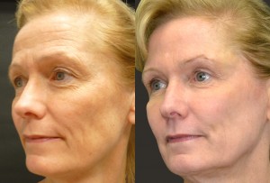 Laser resurfacing, fillers, fat grafting, and Botox before and after pictures