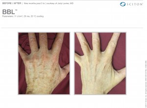 BBL Before and after pictures hands