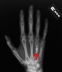 Hand Fractures with screw