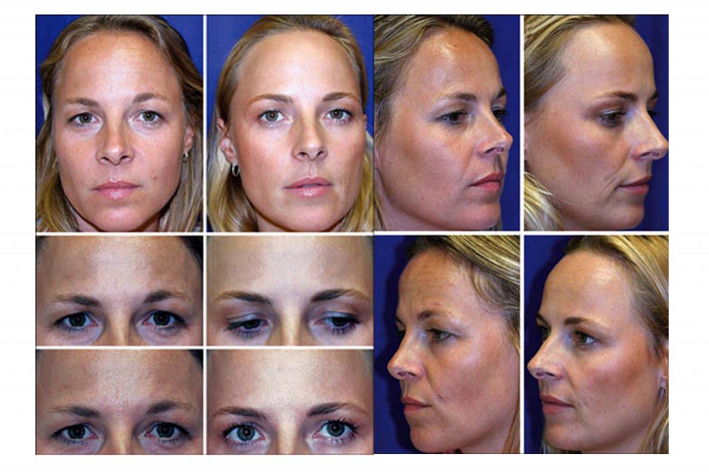 Identical twins botox study