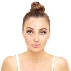 Woman with acne scars on half her face