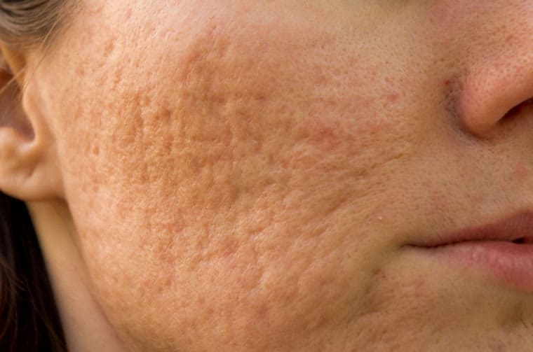 Treatments For Acne Scarring Nova