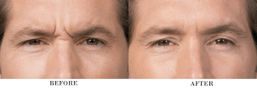 4 Benefits of Botox (Before/After Photos)