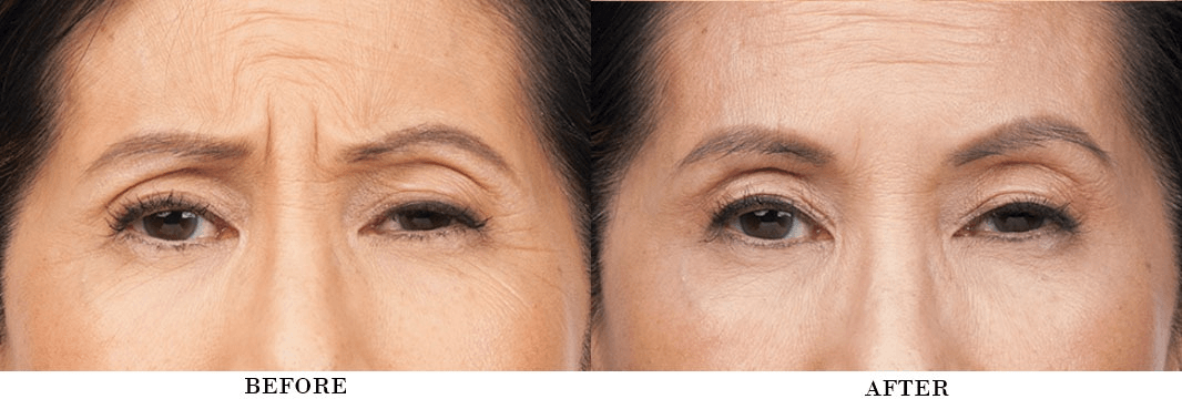 4 Benefits of Botox (Before/After Photos)