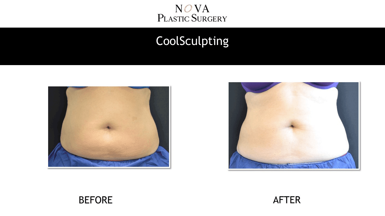 Real Before/After photos CoolSculpting