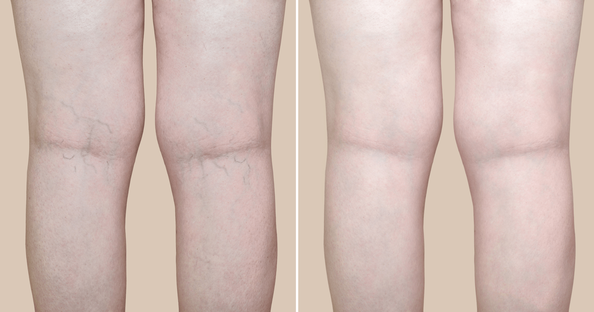 Spider Veins on legs before and after