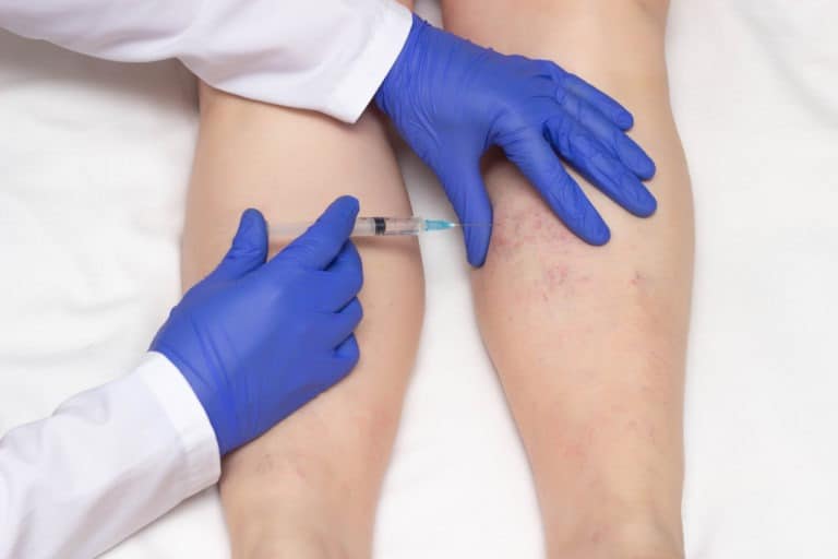 What Is Sclerotherapy and Is It Right for Me?