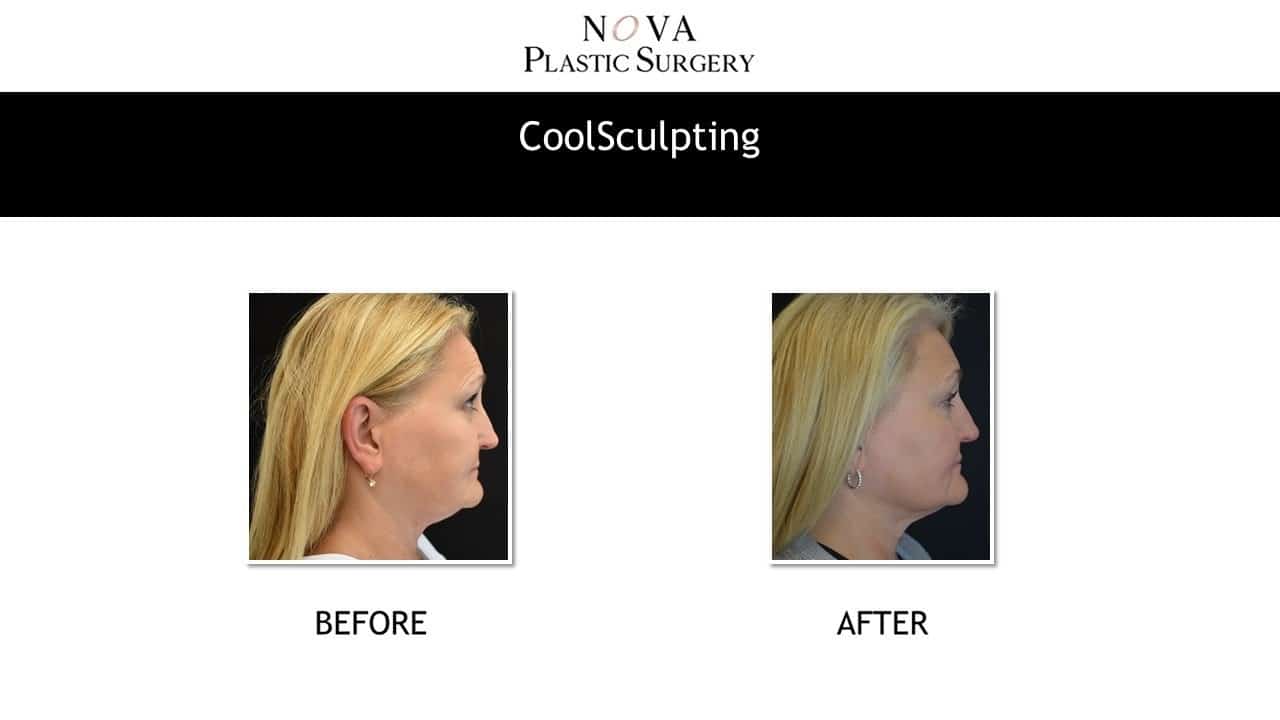 CoolSculpting Results