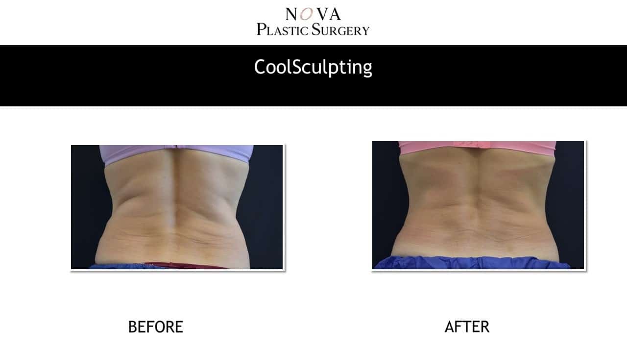 CoolSculpting Before and After 80