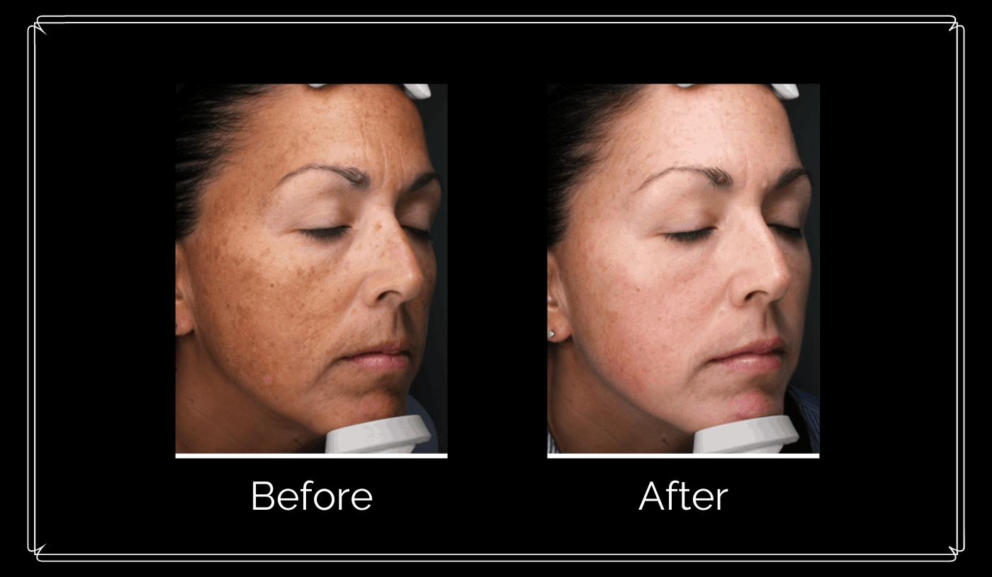 Skin treatment actual patient results right side angle