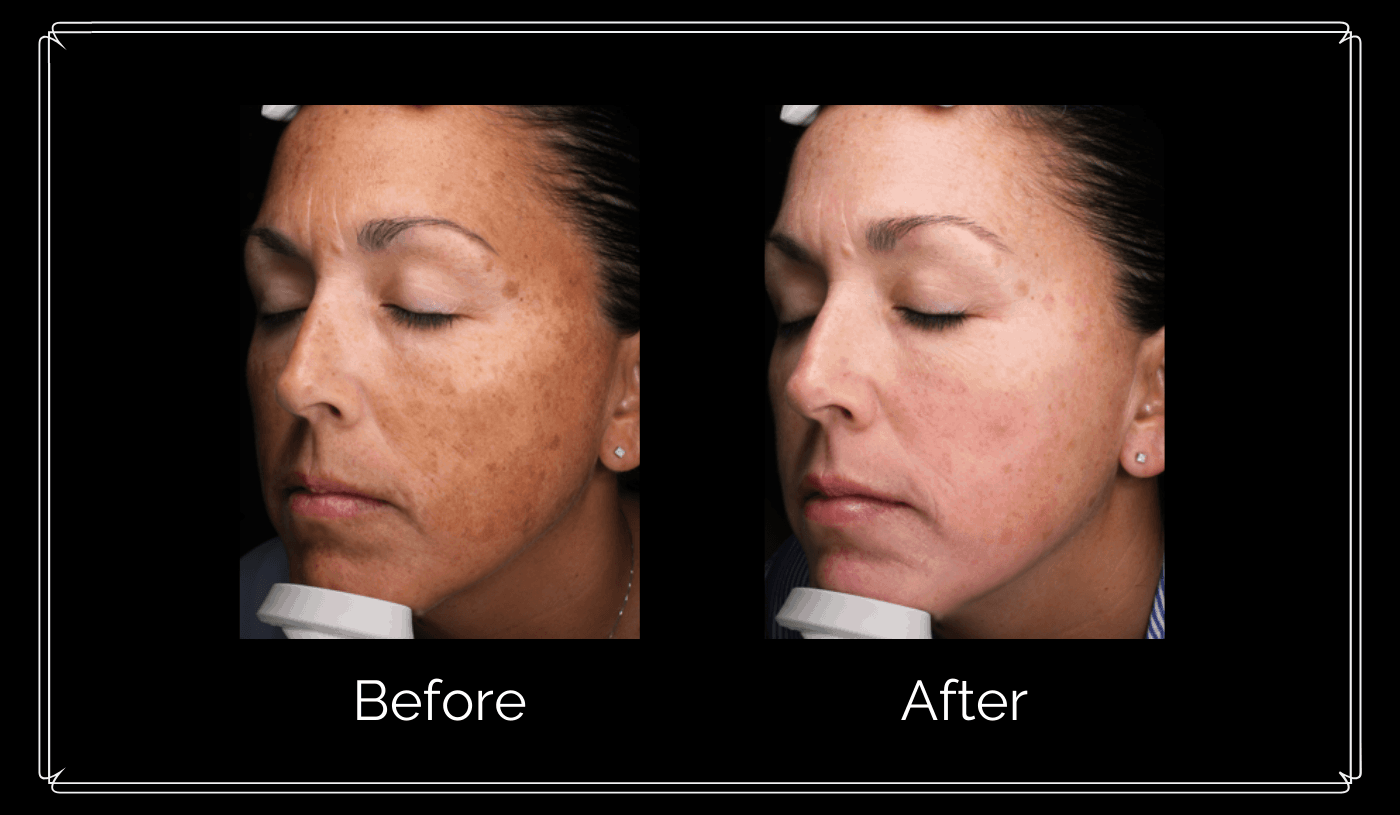Skin treatment actual patient results side angle