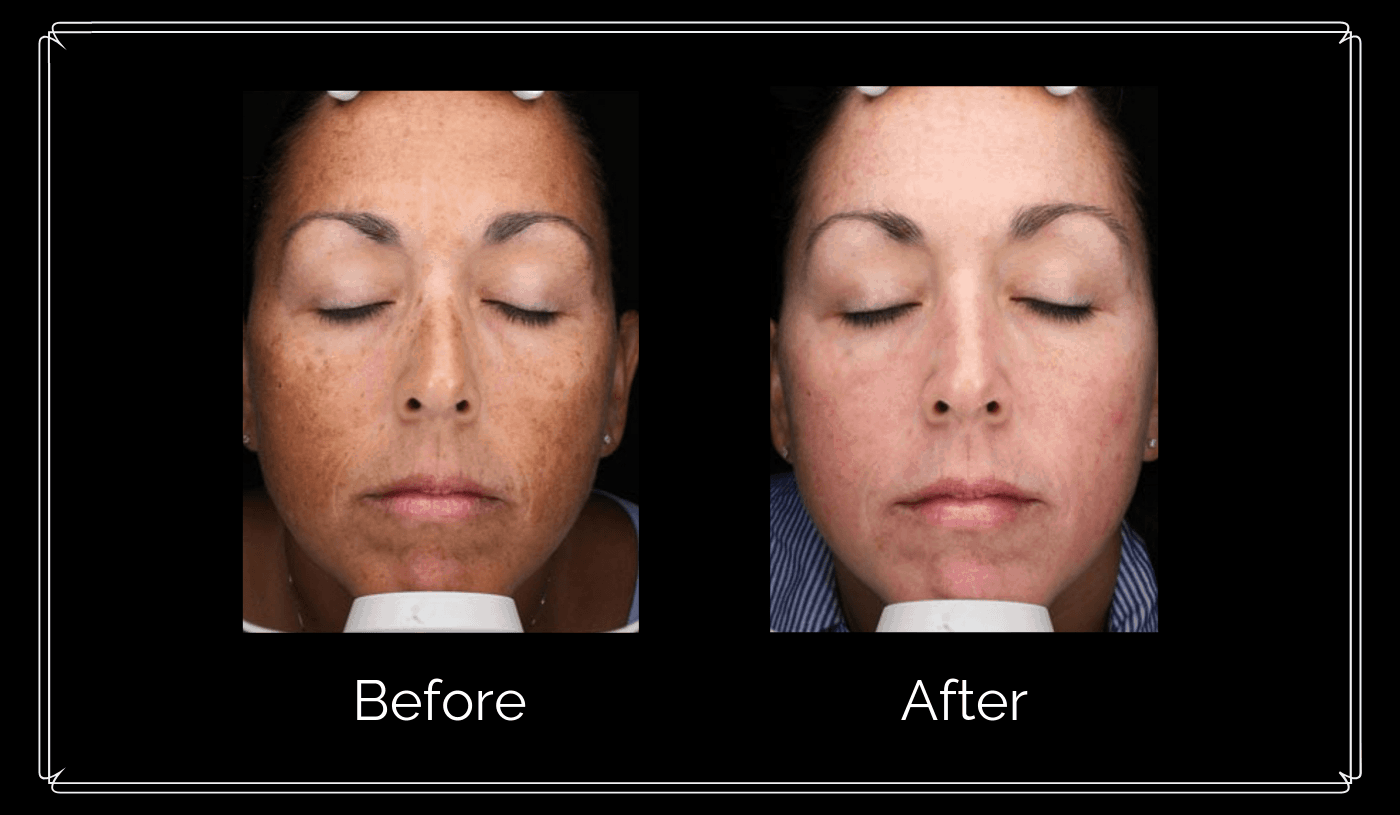 Skin treatment actual patient results front view