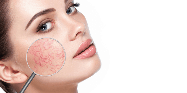 The Most Effective Way to Treat Spider Veins on Your Face