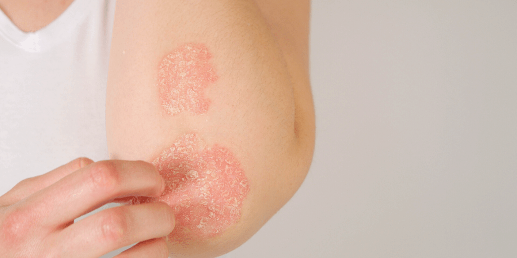 Psoriasis vs. Eczema What’s the Difference? NOVA Plastic Surgery and Dermatology