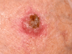 Example of Squamous Cell Carcinoma
