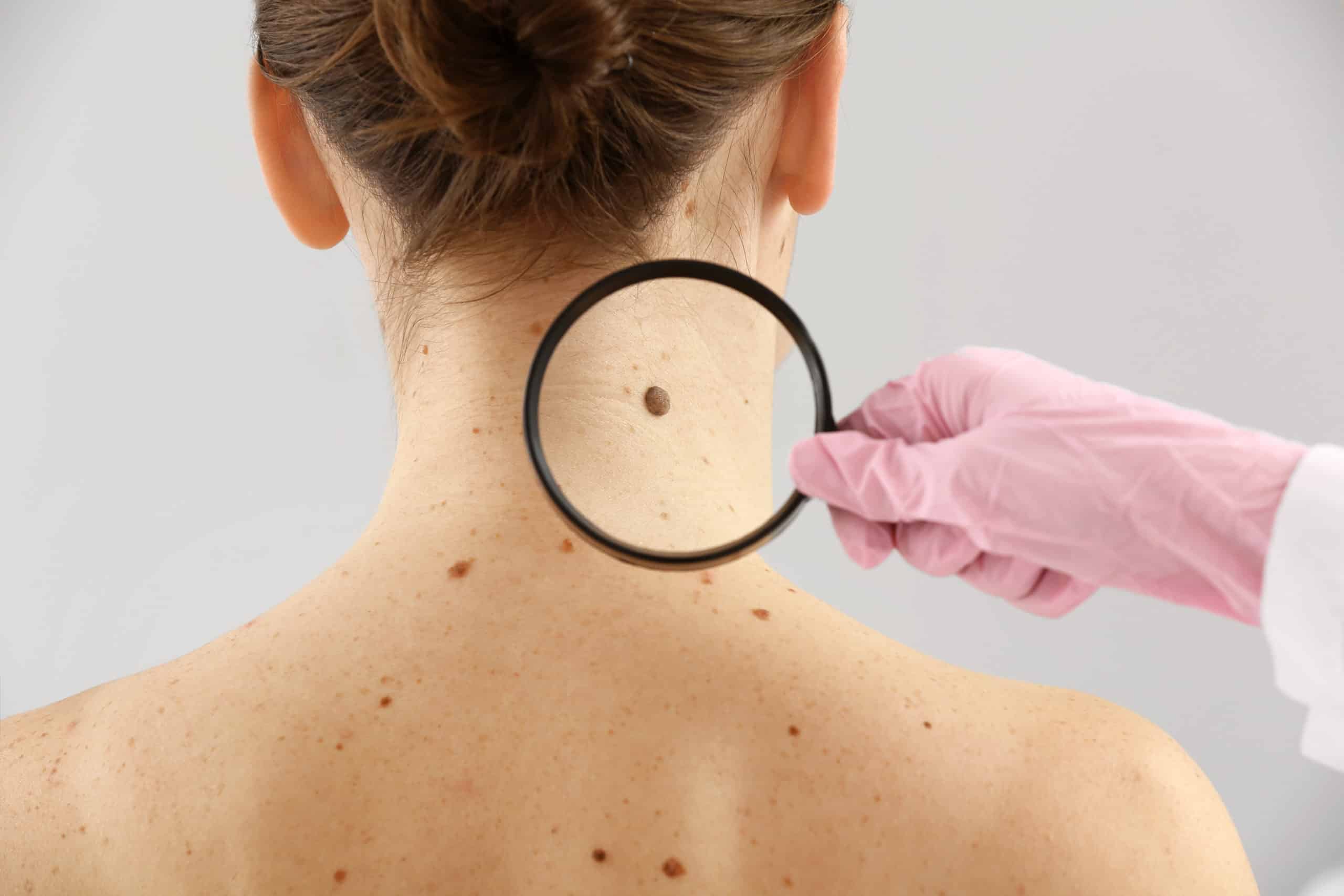 Woman with a mole on her neck