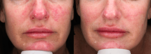 Facial flushing actual patient results