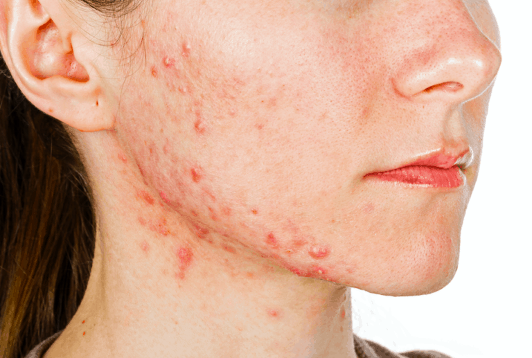 How Polycystic Ovarian Syndrome Effects Your Skin