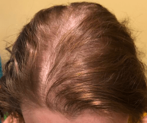 Woman with alopecia