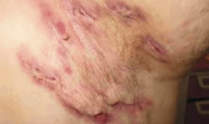 Skin with Hidradenitis Suppurativa