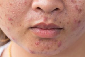 Young woman with acne scars