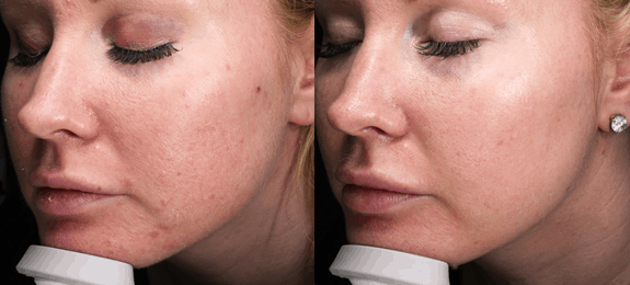 Acne Patient 1