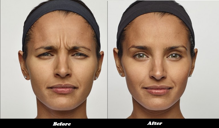 Before and after results of Dysport treatment