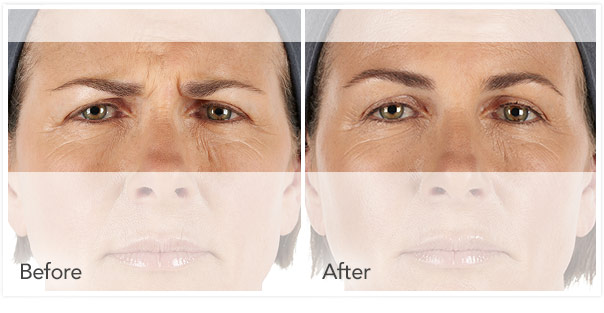 Before and after photo of Xeomin around the eye area
