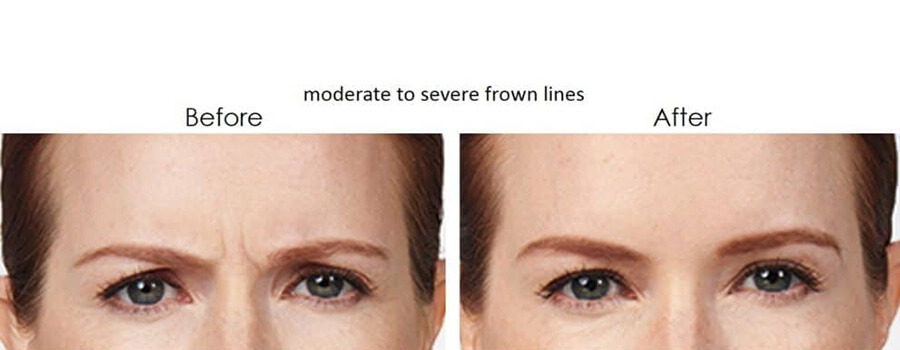 Before and after results of a botox - female patient 1