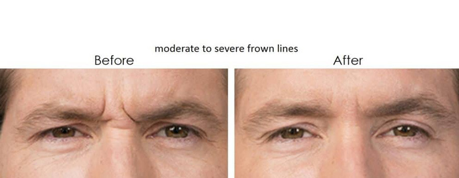 Before and after results of a botox - male patient 1