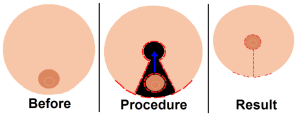 Animated diagram of the Breast Reduction Process