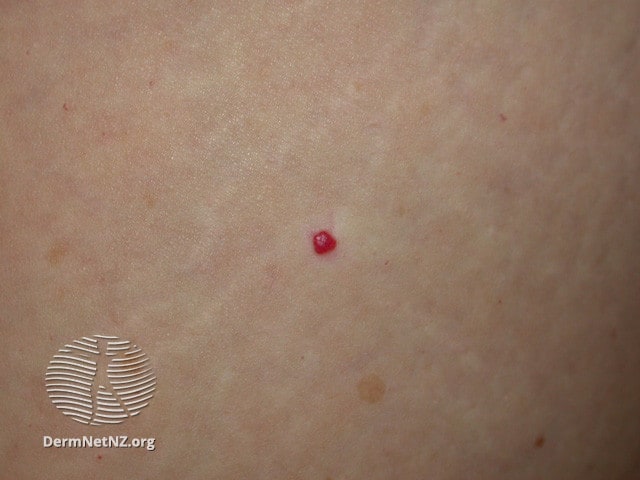 Example of Cherry Angiomas