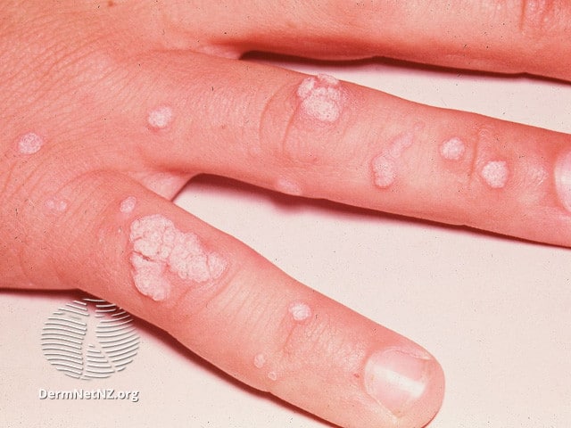 Example of Warts