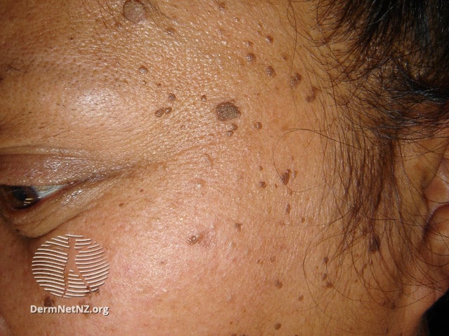 Example of Dermatosis Papulosa Nigra (DPN)
