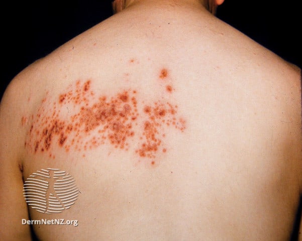 Example of Herpes Zoster (Shingles)