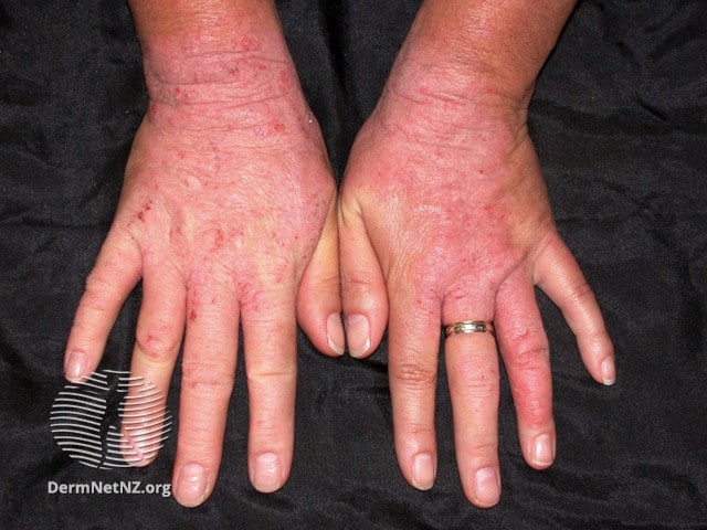 Example of Irritant Contact Dermatitis