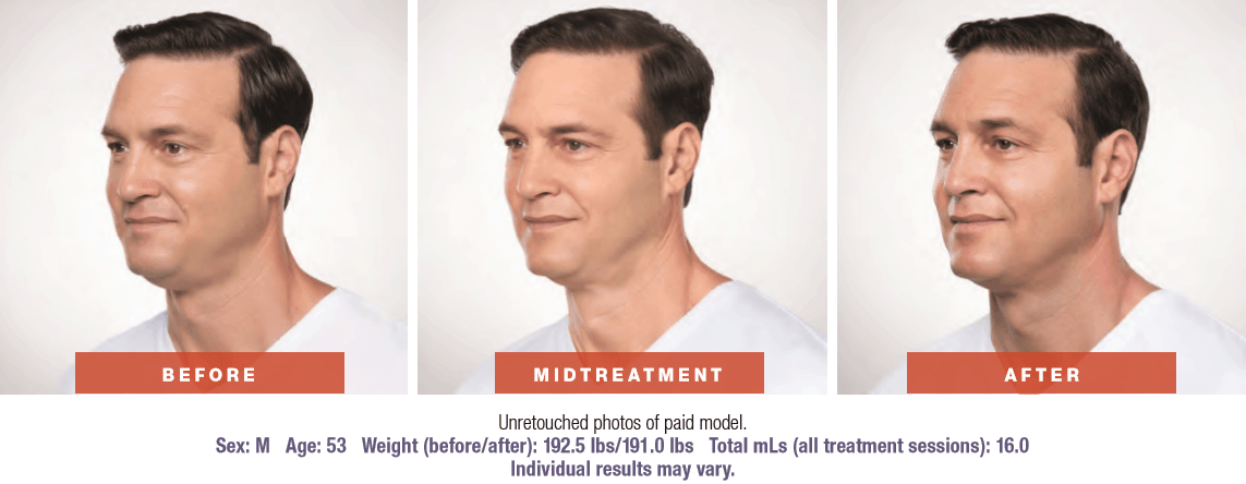 3 part results of Kybella treatment for male patient