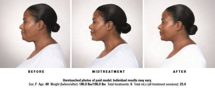 3 part results of Kybella treatment for female patient