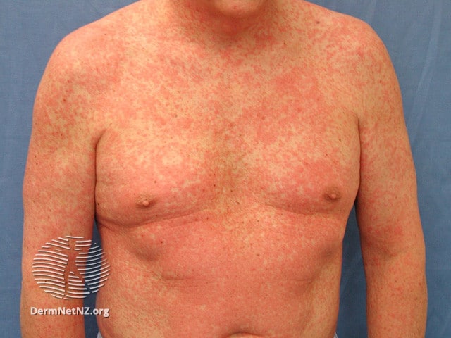 Example of Exanthem or Morbilliform Rash