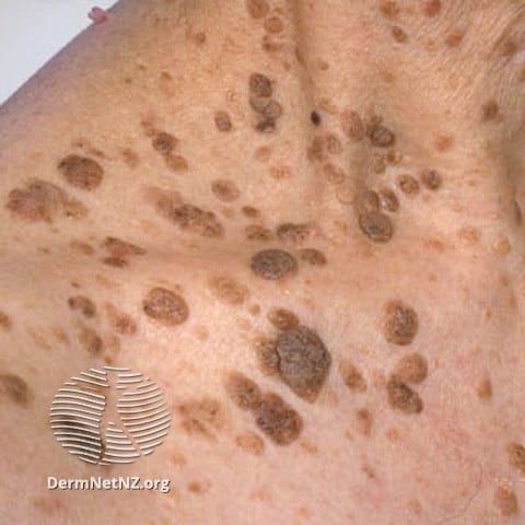 Example of Seborrheic Keratosis