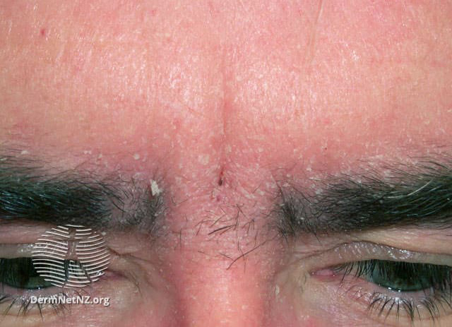 Example of Seborrheic Dermatitis