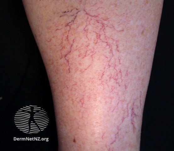 Example of Telangectasias (Spider Veins)