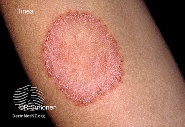 Example of Tinea Corporis (Ringworm)