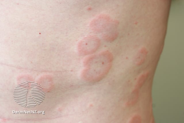 Example of Urticaria (Hives)