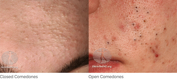 Acne Patient 2